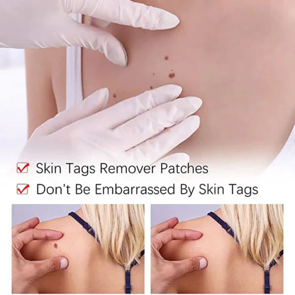 Tags And  Moles Remover